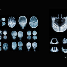 Hyper XRays