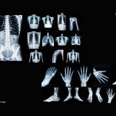 Hyper XRays